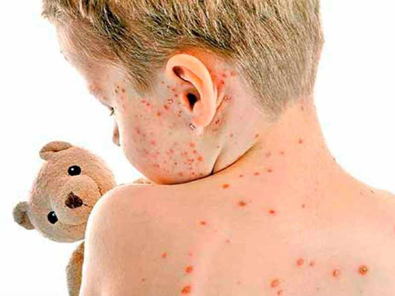 ¿Qué es la varicela?