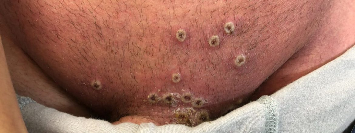 La viruela del mono afecta más a los homosexuales